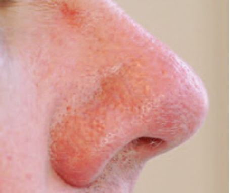 Nose after ThermaVein treatment showing reduced visible facial veins