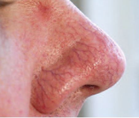 Visible facial thread veins on the nose before ThermaVein treatment